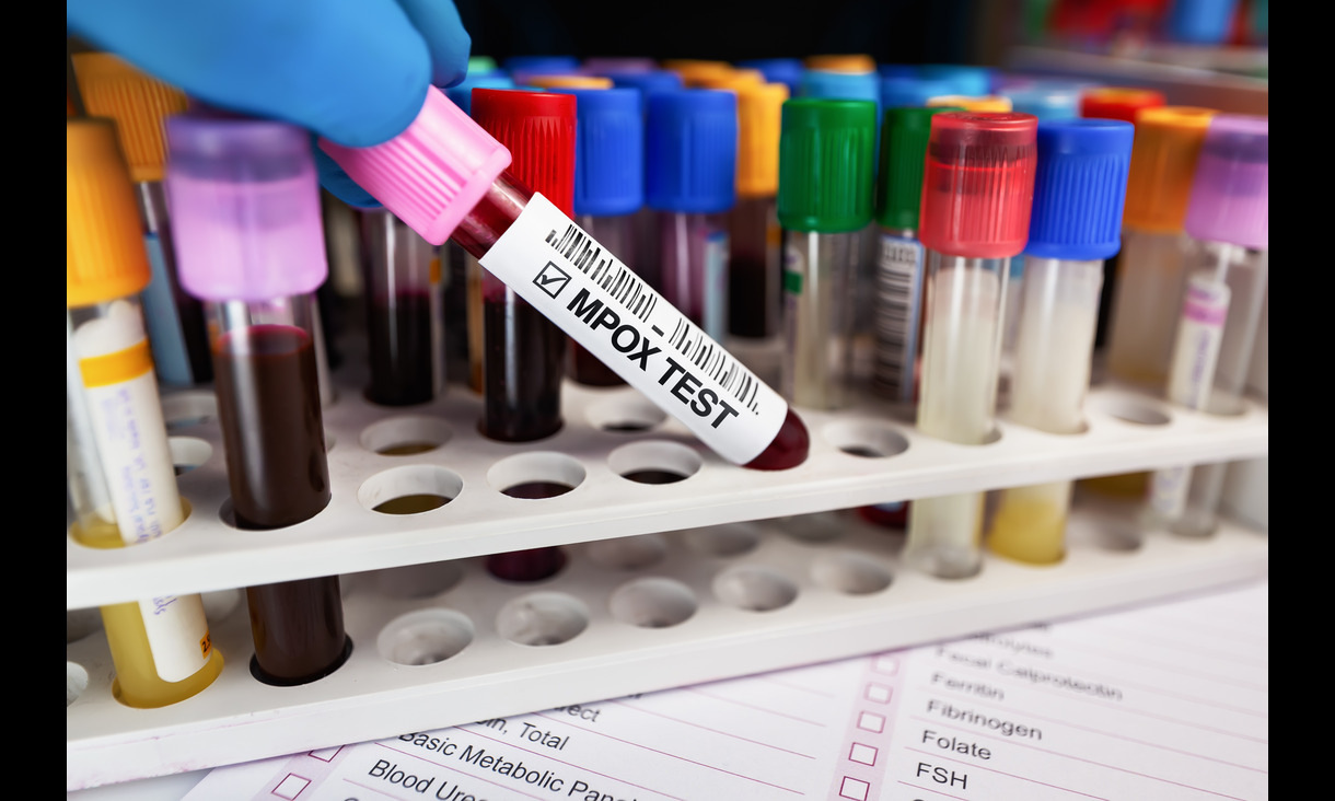 gloved hand holds vial labelled MPOX TEST with other glass vials wih multi-coloured lids in the background